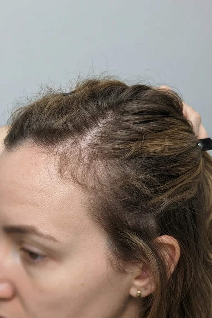 Visible breakage and thinning along the hairline, close-up view